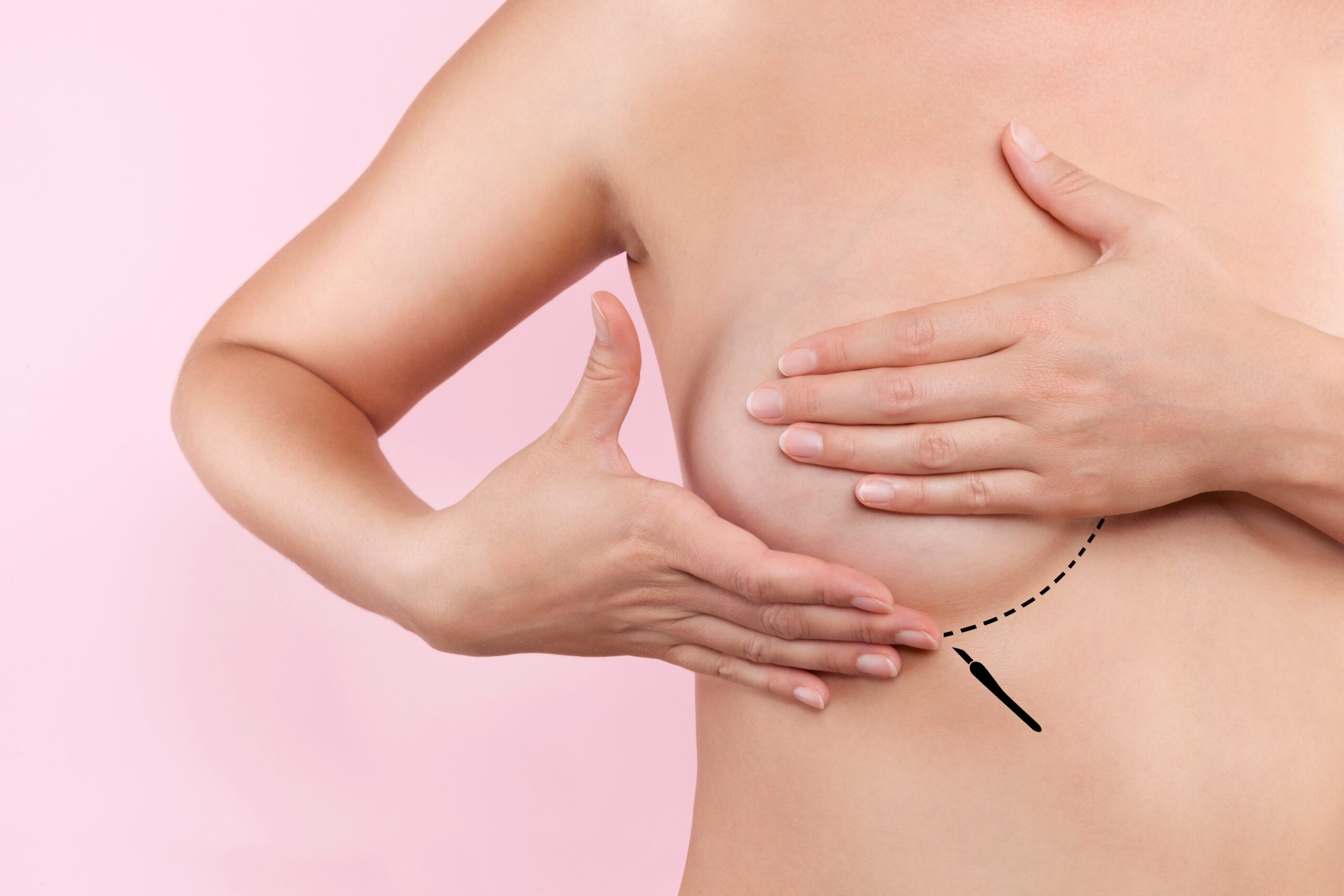 cicatrices après chirurgie mammaire